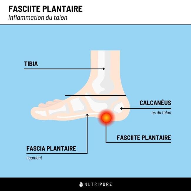 Fasciite plantaire schéma